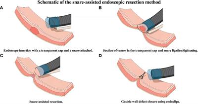 Advances in endoscopic resection techniques of small gastric tumors originating from the muscularis propria